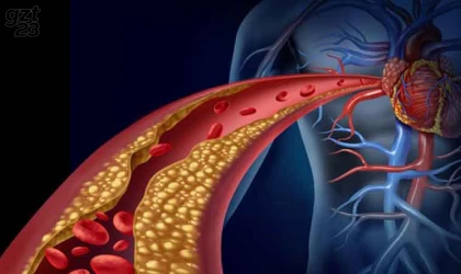 Kireçleşmiş damar tıkanıklıklarına rotablasyon tedavisi